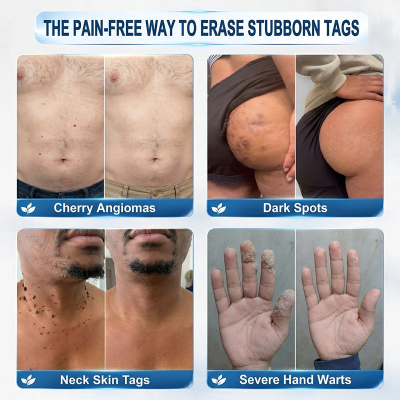 DermaRollix™ Skin Spot Removal Roller