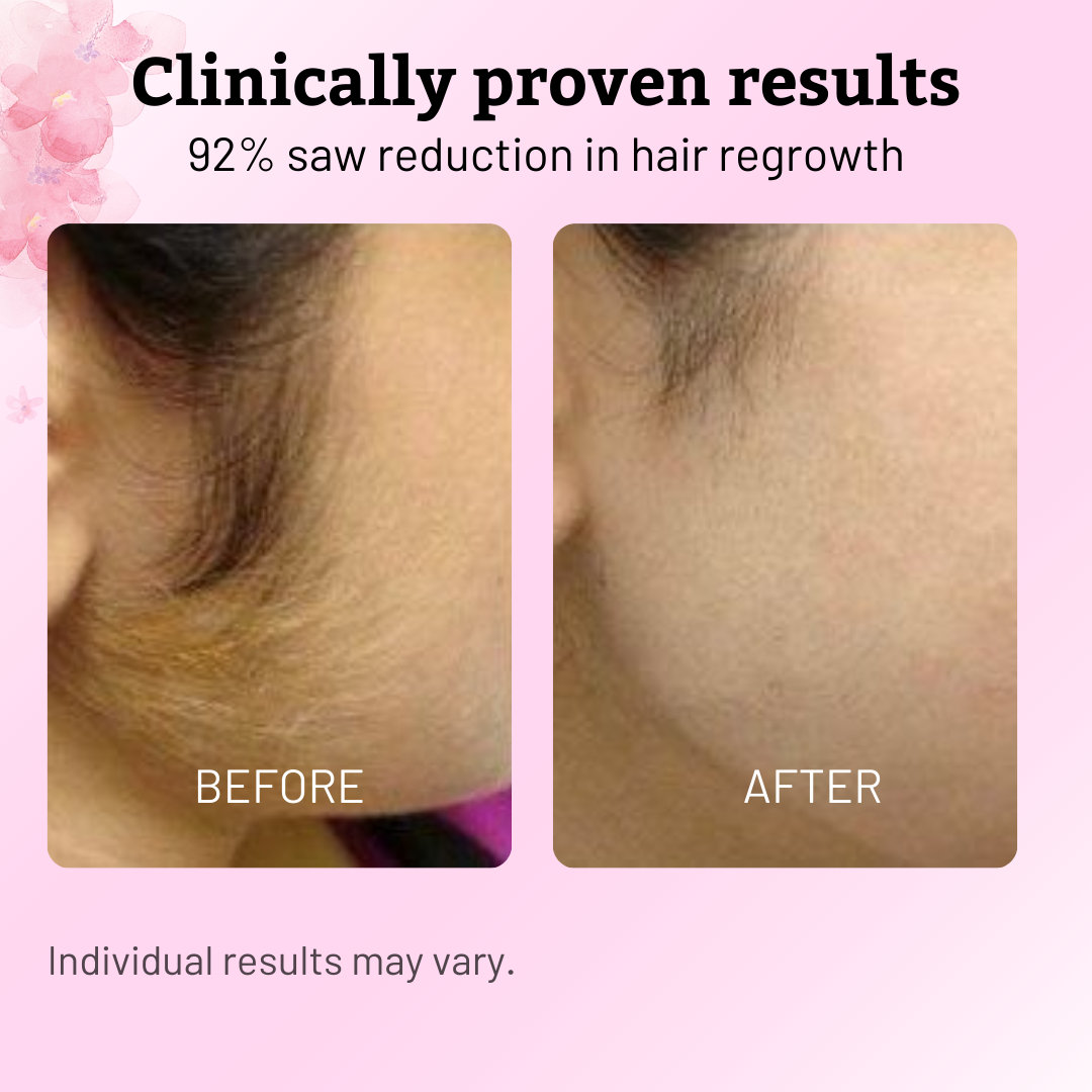 SilkRoot™ Cyperus Rotundus Hair Reduction Oil
