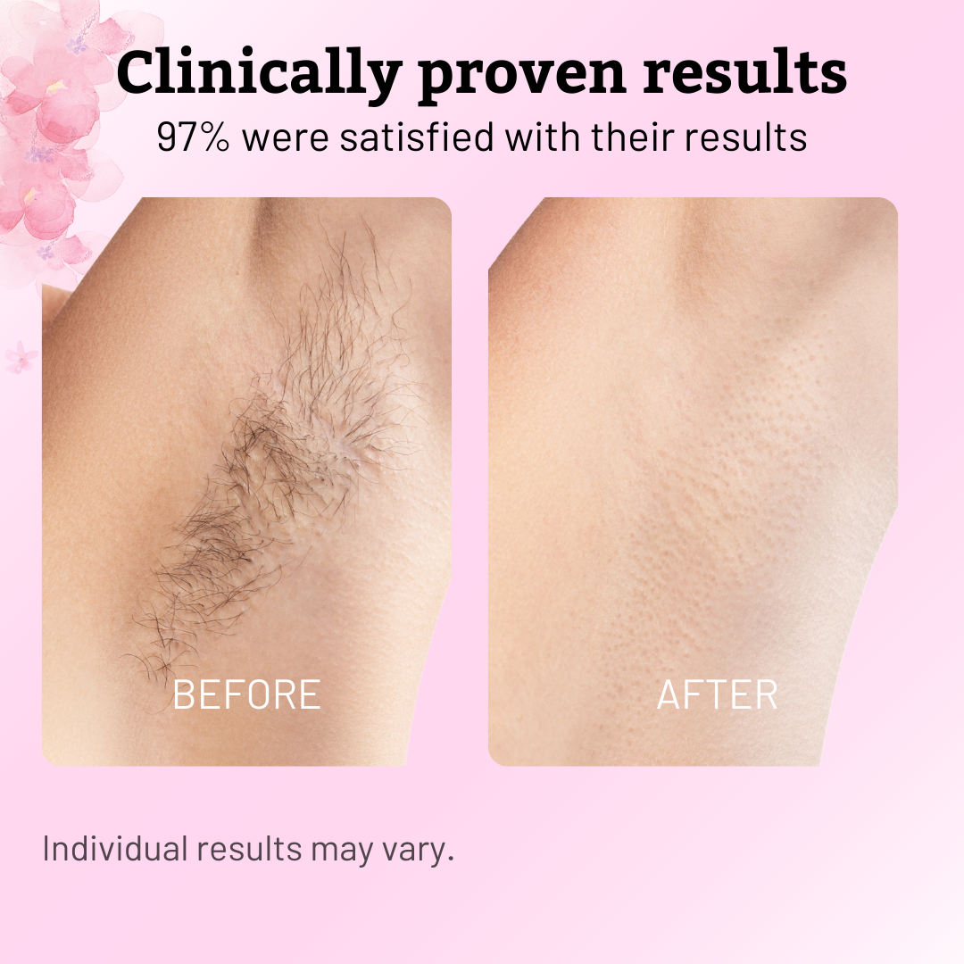 SilkRoot™ Cyperus Rotundus Hair Reduction Oil