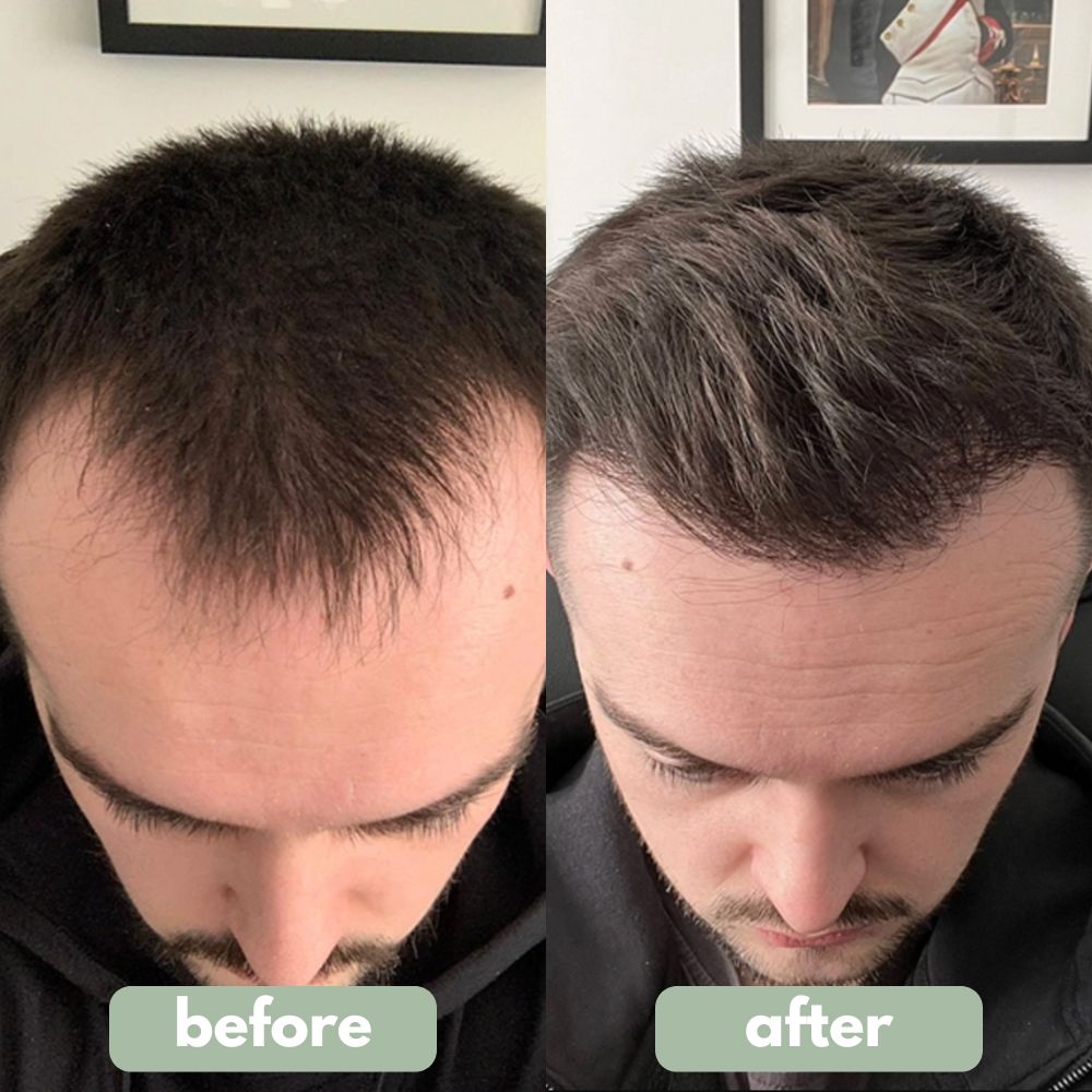 RootRevive™ Hair Growth Roll-On Serum